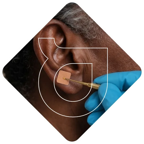 Aplicação de auriculoterapia